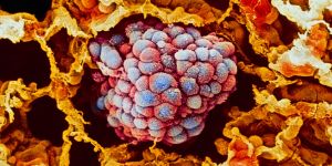 "Biológiai drónokat" vetnek be a rákos sejtek az immunrendszer elleni harcukban